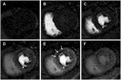 Clinical Application of Dynamic Contrast Enhanced Perfusion Imaging by Cardiovascular Magnetic Resonance